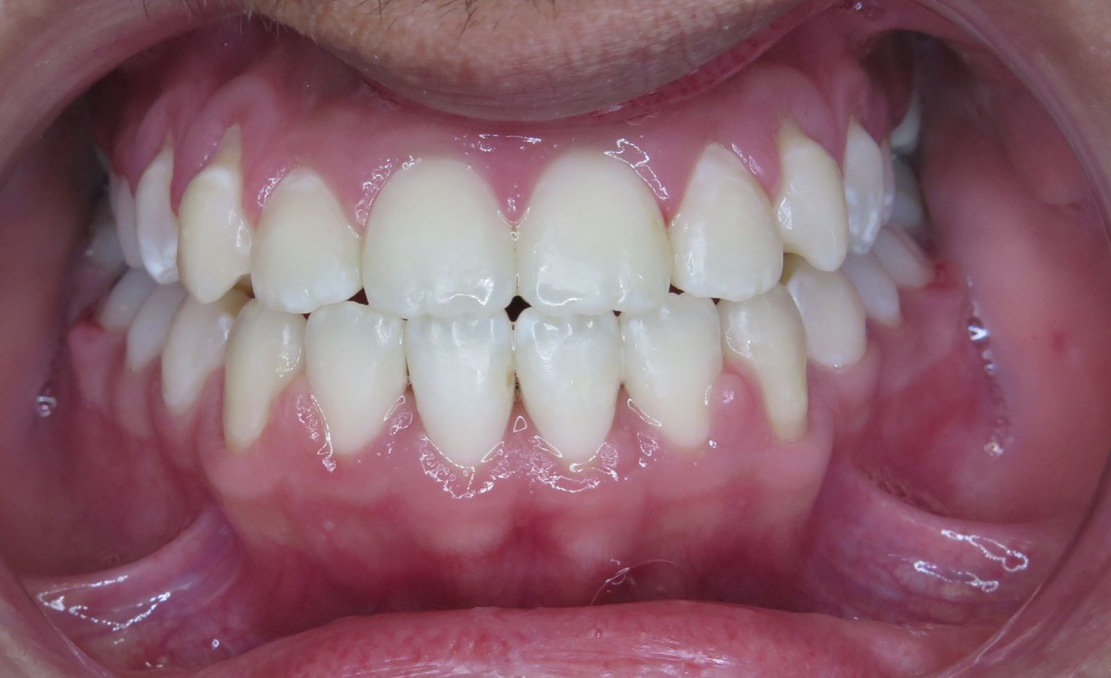 Before and After Oakridge Orthodontics Vancouver BC